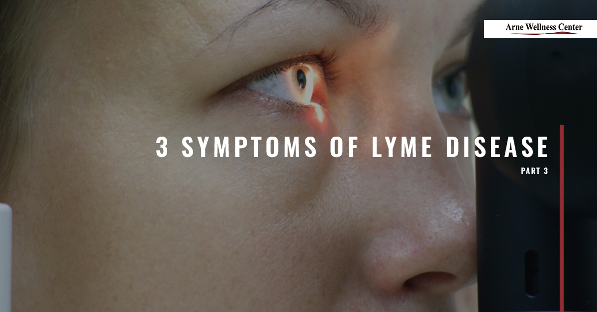 3-Symptoms-of-Lyme-Disease-59ffb9da72715