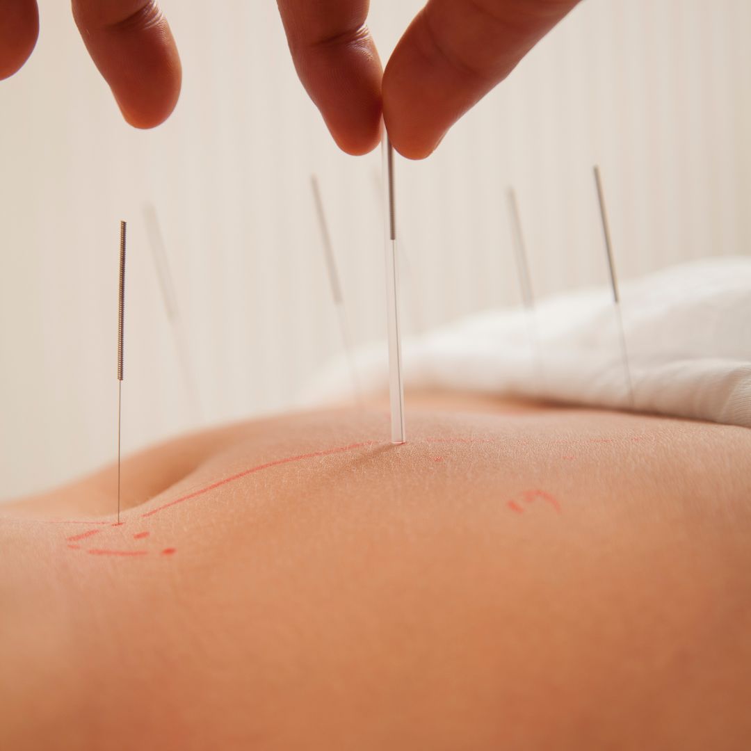 Acupuncture
