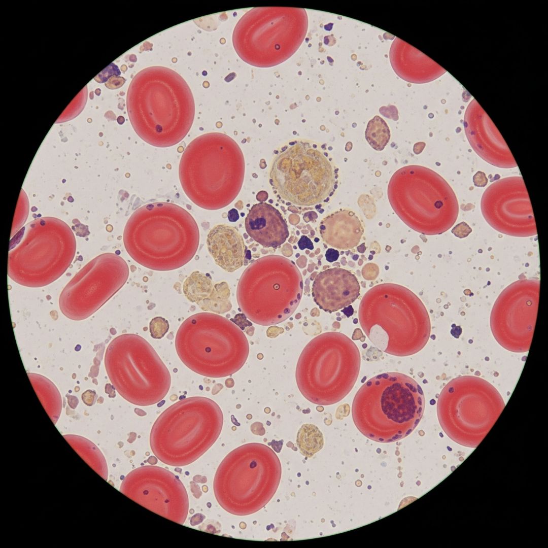A microscopic view of blood cells mixed with cellular debris, representing the effects of inflammation.
