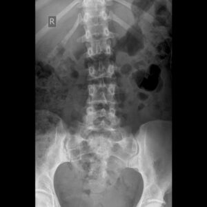 x-ray of someone's spine